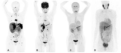 Clinical, Diagnostic, and Treatment Characteristics of SDHA-Related Metastatic Pheochromocytoma and Paraganglioma